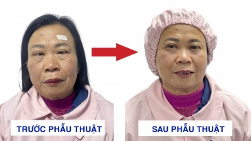 60 năm sống với đôi mắt lác: “Tôi ước gì mình dám thay đổi sớm hơn…”