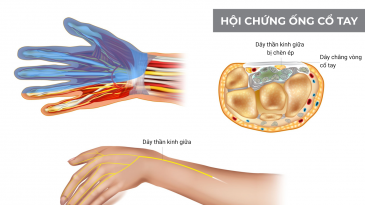 5 bác sĩ khám và điều trị Hội chứng ống cổ tay giỏi tại Hà Nội