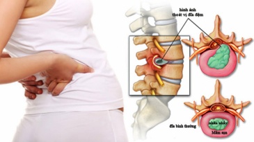 Top 6 Bác Sĩ Điều Trị Thoát Vị Đĩa Đệm Cột Sống Thắt Lưng Tốt Nhất Tại Hà Nội (Cập nhật 2026)