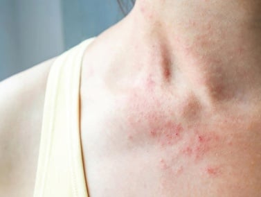 giá xét nghiệm 60 dị nguyên tại medlatec