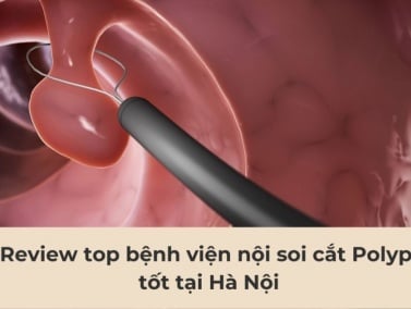 Nội soi cắt polyp ở đâu tốt tại Hà Nội: Đánh giá 7 bệnh viện hàng đầu