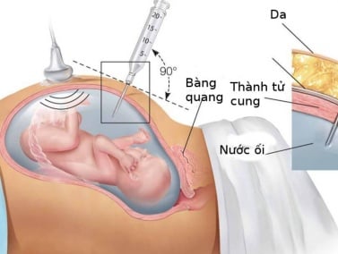 Địa chỉ Sàng Lọc Trước Sinh và Sơ Sinh Tại Hà Nội