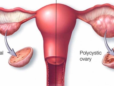 6 Dấu Hiệu Nhận Biết U Nang Buồng Trứng Không Nên Bỏ Qua