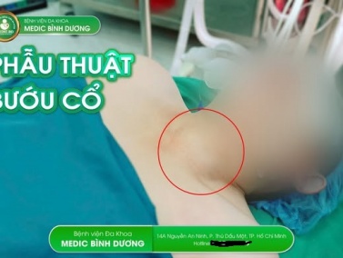 Bướu Cổ: Hiểu Rõ Để Sống Khỏe Và Tự Tin