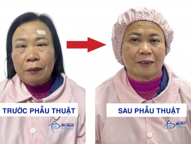 60 năm sống với đôi mắt lác: “Tôi ước gì mình dám thay đổi sớm hơn…”