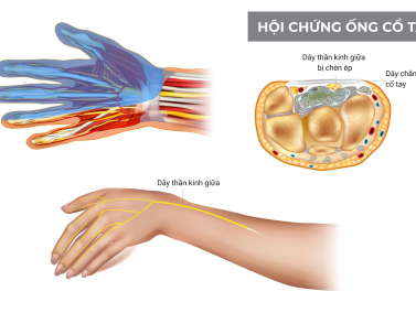 5 bác sĩ khám và điều trị Hội chứng ống cổ tay giỏi tại Hà Nội