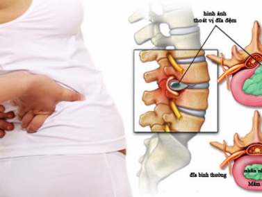 Top 6 Bác Sĩ Điều Trị Thoát Vị Đĩa Đệm Cột Sống Thắt Lưng Tốt Nhất Tại Hà Nội (Cập nhật 2026)