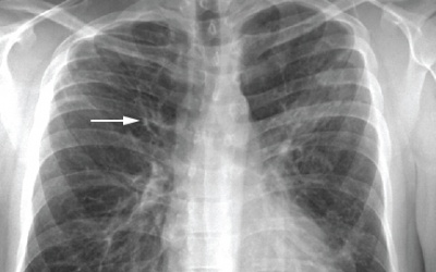 Bệnh phế quản phế viêm: Cách điều trị - Đau đớn và khó thở là những triệu chứng chính của bệnh phế quản phế viêm. Để giảm thiểu các triệu chứng đau đớn và thở khó, bạn cần thực hiện chế độ ăn uống và hỗ trợ điều trị thích hợp. Hãy xem hình ảnh để biết cách điều trị đúng cách.