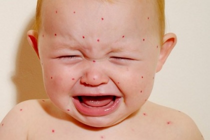 Trẻ sơ sinh khi bị bệnh sởi và Cách Chăm sóc