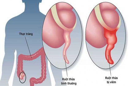 Viêm ruột thừa: Triệu chứng, nguyên nhân, biến chứng và cách điều trị