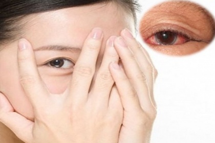 Viêm giác mạc: Nguyên nhân, triệu chứng, cách phòng tránh