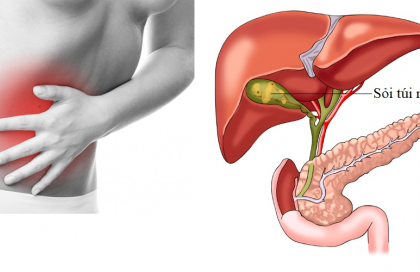 Sỏi túi mật là bệnh gì? Nguyên nhân, triệu chứng và cách điều trị