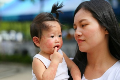 Bệnh tay chân miệng có lây không? Lây qua đường nào?