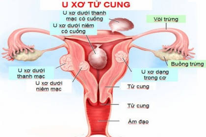 Biến chứng của u xơ tử cung: Những điều bạn cần biết!