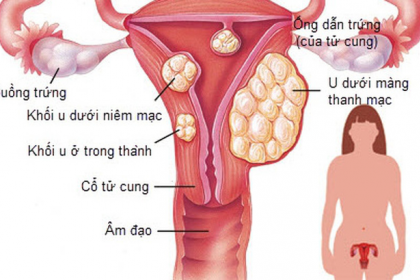 U xơ tử cung ác tính là gì? Cách điều trị