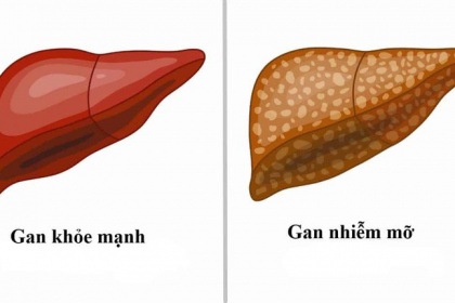 Gan nhiễm mỡ cấp độ 2 Những điều cần biết