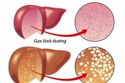 Người bị bệnh gan nhiễm mỡ lên ăn gì, không lên ăn gì?