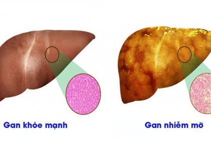 Gan nhiễm mỡ cấp độ 1 là gì?