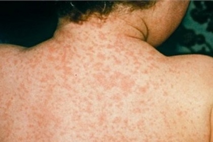 Rubella là bệnh gì? Nguyên nhân, triệu chứng, biến chứng và cách đề phòng