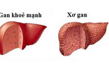 Kiểm tra chức năng gan như thế nào?