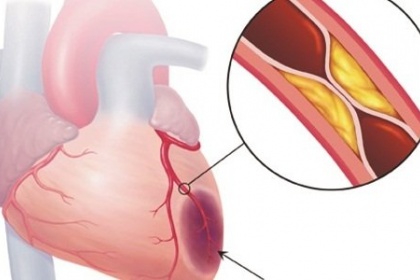 Chụp mạch vành - Trong Chẩn đoán và điều trị bệnh mạch vành