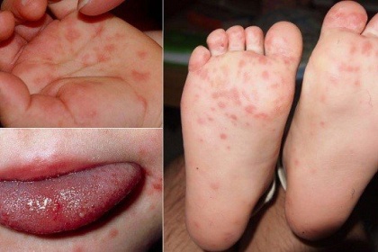 Bệnh tay chân miệng ở trẻ bao lâu thì khỏi?