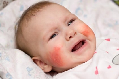Một số bệnh dị ứng hay gặp ở trẻ em