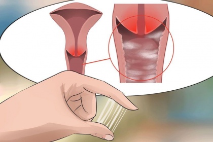Viêm nhiễm âm đạo là nguyên nhân hàng đầu gây tắc ống dẫn trứng
