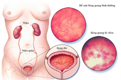 Viêm bàng quang cấp có nguy hiểm không?