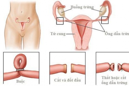 Nối ống dẫn trứng để tiếp tục sinh con được không?