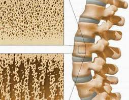 Thiếu canxi - nguyên nhân hàng đầu gây loãng xương và các bệnh cơ xương khớp