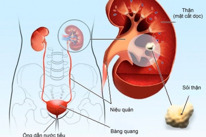 Sỏi thận hình thành như thế nào?