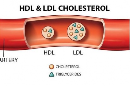 Chỉ số mỡ máu Triglyceride và biến chứng nguy hiểm cần lưu ý