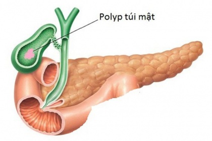 Polyp túi mật là bệnh gì, Triệu chứng và có cần phải điều trị không?