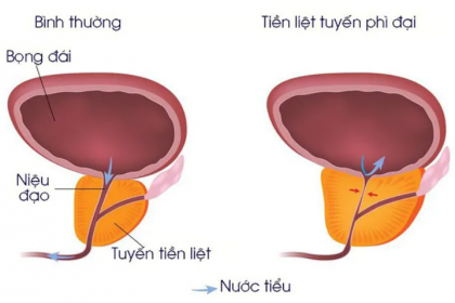 Bệnh tăng sinh lành tính tuyến tiền liệt (u xơ tuyến tiền liệt): độ tuổi nào mắc bệnh