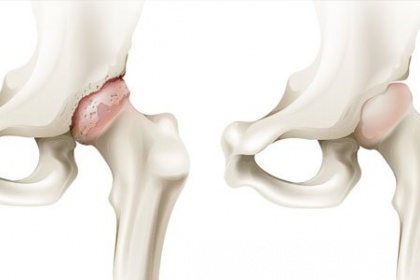 Các biện pháp điều trị hoại tử (tiêu) chỏm xương đùi nặng