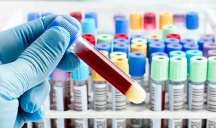 Xét nghiệm máu có phát hiện bệnh ung thư hay không?