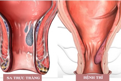 Sa trực tràng và trĩ có giống nhau không?