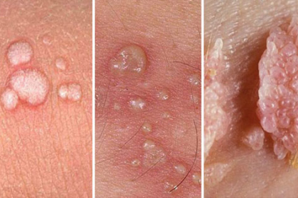 Mụn rộp sinh dục có phải là sùi mào gà không?