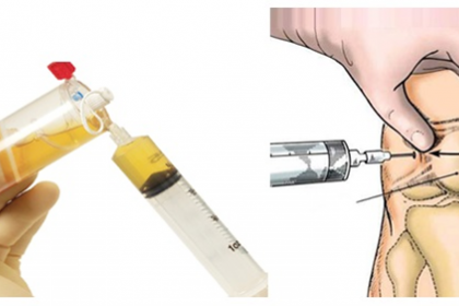 Điều trị bệnh viêm điểm bám gân bằng phương pháp tiêm huyết tương giàu tiểu cầu PRP