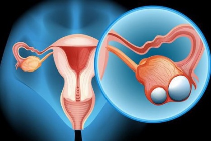 Mổ nội soi cho bệnh nhân ung thư buồng trứng giai đoạn sớm