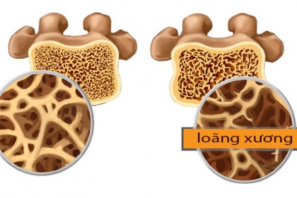 Đo mật độ xương để phát hiện nguy cơ loãng xương