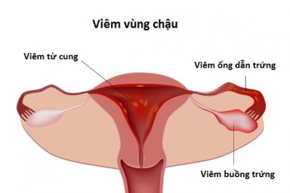 Viêm vùng chậu là bệnh gì? Nguyên nhân, triệu chứng và cách phòng ngừa