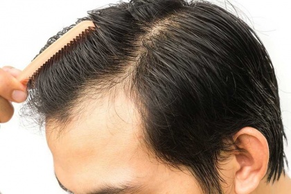 Cấy tóc: Những điều cần biết
