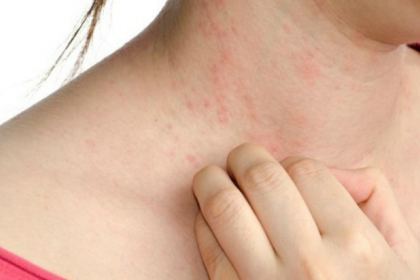 Bị sốt xuất huyết có ngứa không?