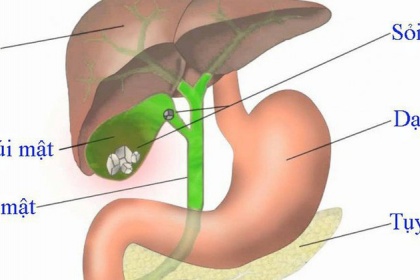 Cắt bỏ túi mật ảnh hưởng gì đến sức khoẻ?