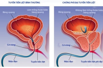 Phì đại tiền liệt tuyến: Khi nào cần mổ?