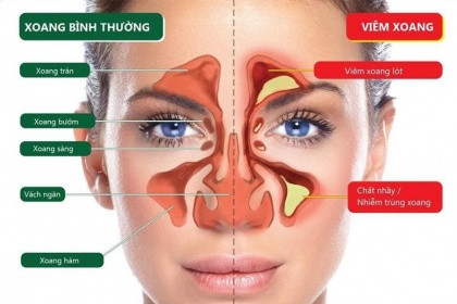 Cách chăm sóc người bị bệnh viêm xoang cấp
