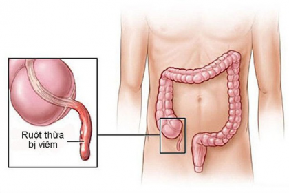 Chẩn đoán và điều trị viêm ruột thừa cấp