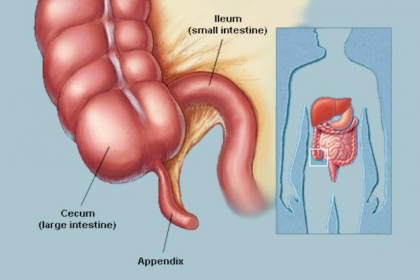 Dấu hiệu nhân biết viêm ruột thừa cấp tính